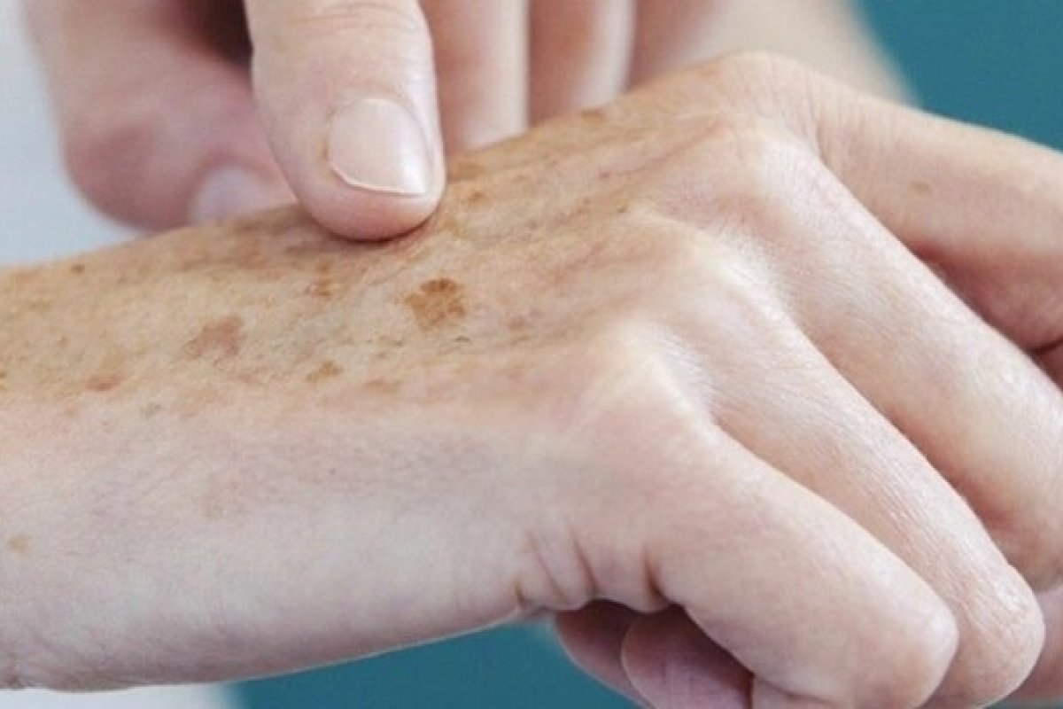 [Câncer de pele: Ministério da Saúde abre consulta sobre diagnóstico da doença ]
