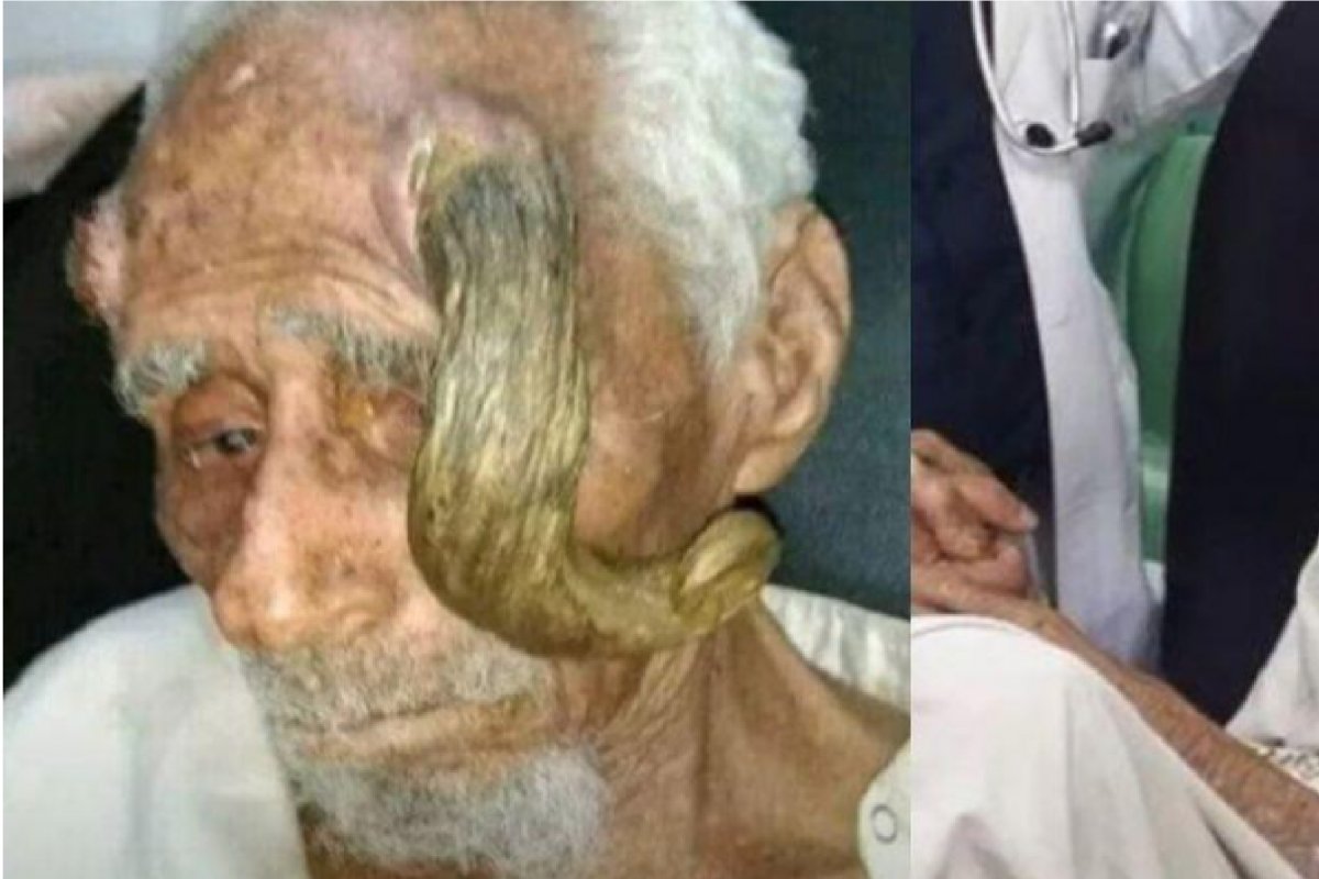 [Homem que afirmava ter 140 anos morre após cirurgia para tirar 'chifres']