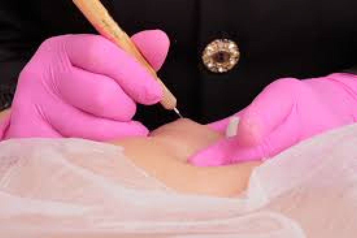 [Micropigmentação paramédica pode auxiliar na redução e suavização de cicatrizes pós-cirúrgicas]